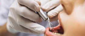 What Are The Possible Complications After A Root Canal Treatment?